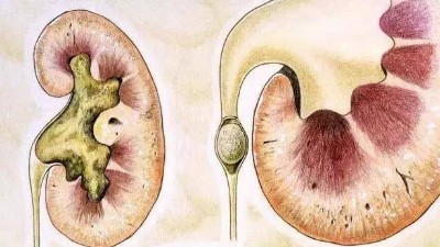 腎結(jié)石是怎么引起的？