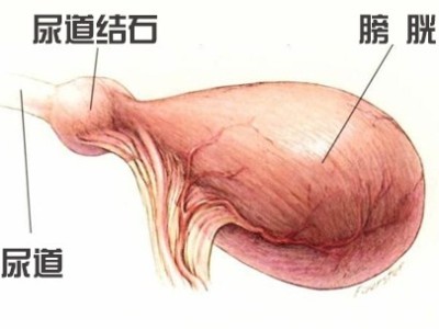 尿道結石