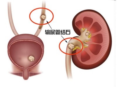 輸尿管結石