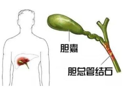膽總管結石