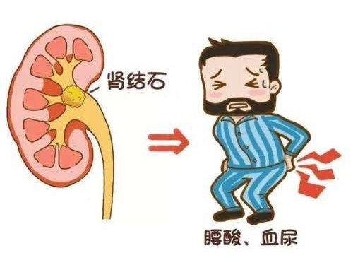 得了腎結(jié)石怎么辦？